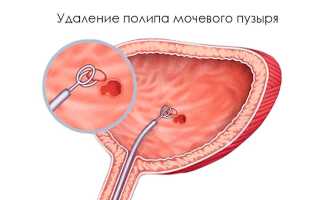 Что такое полипы в урологии