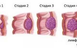 Интоксикация при раке предстательной железы
