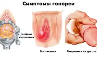 Может ли молочница перейти в гонорею