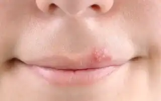 Высыпала малярия на подбородке