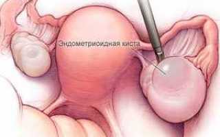 Лечение кисты яичника без операции: эффективные методы