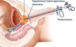 Лечение аденомы простаты, чем и как лечить аденому у мужчин