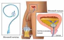 Чем смазывать урологические катетеры