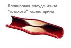 Атеросклероз артерий в икрах