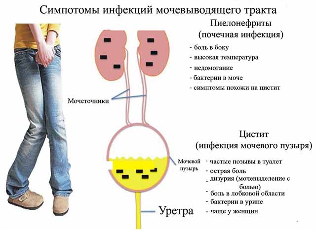 Цистит, пиелонефрит