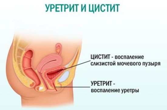 Уретрит и цистит