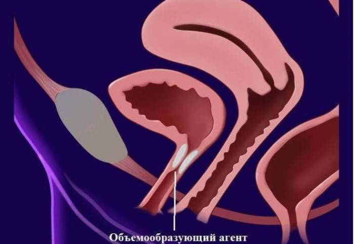 Как используется гиалуроновая кислота при цистите?
